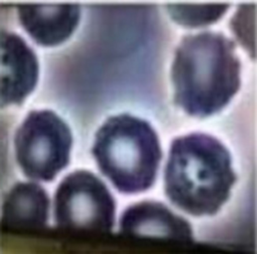 Microscopic Images Show Foreign Nano Particles in Blood after COVID&nbsp;Shot